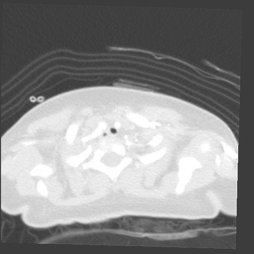 File:Aberrant left pulmonary artery (pulmonary sling) (Radiopaedia 42323-45435 Axial lung window 1).jpg