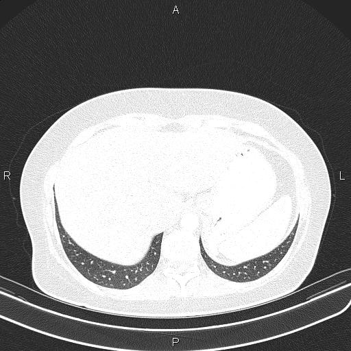 Aberrant right subclavian artery (Radiopaedia 87334-103629 Axial lung window 59).jpg