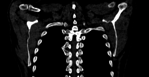 Accesory rib joint (Radiopaedia 71987-82452 Coronal bone window 59).jpg