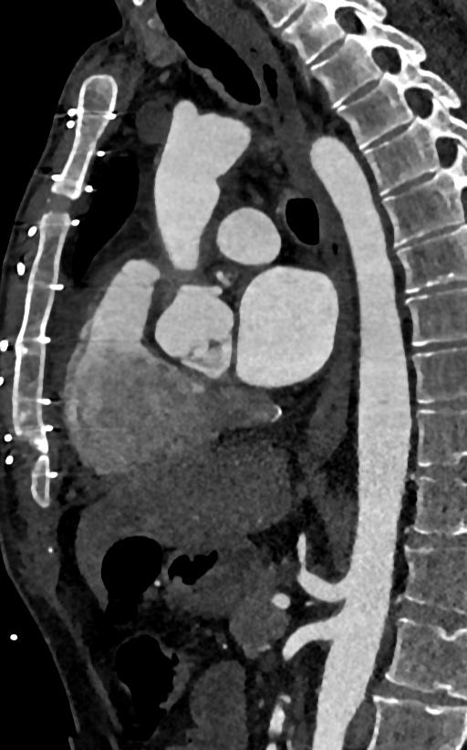 Accessory left atrial appendage (Radiopaedia 81987-95968 Sagittal C+ arterial phase 62).jpg