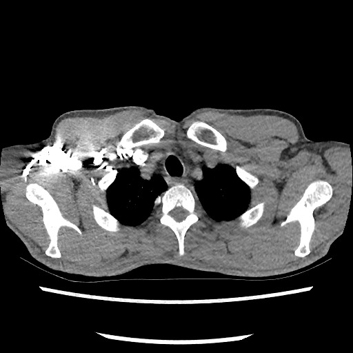 Accessory left horizontal fissure with lingular pneumonia (Radiopaedia 53763-59843 Axial C+ CTPA 13).jpg