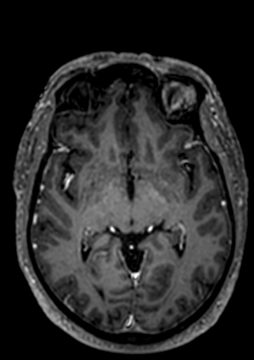 Accessory middle cerebral artery (Radiopaedia 73114-83828 Axial T1 C+ 53).jpg