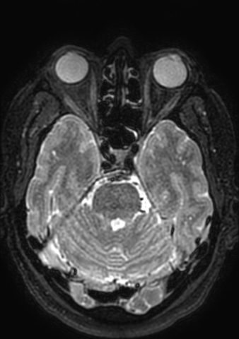 Accessory middle cerebral artery (Radiopaedia 73114-83828 Axial T2 141).jpg