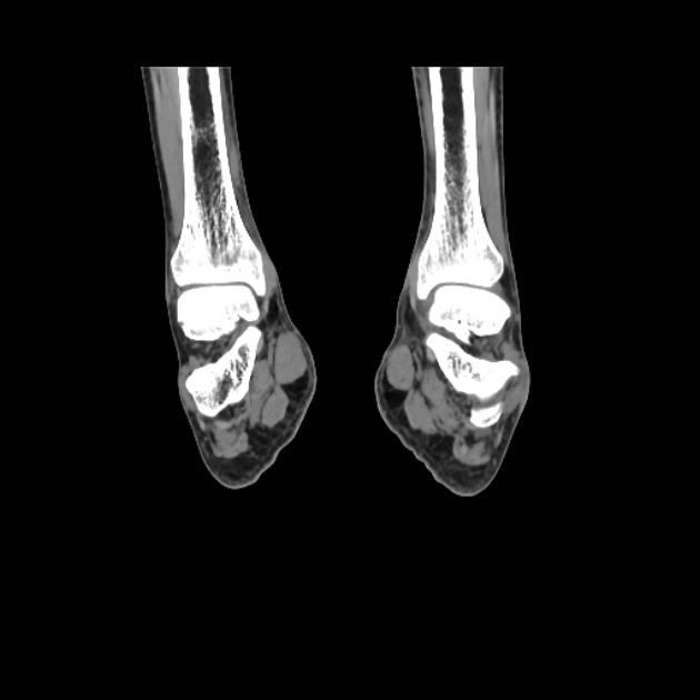 Accessory soleus muscle (Radiopaedia 61069-68943 Coronal non-contrast 43).jpg