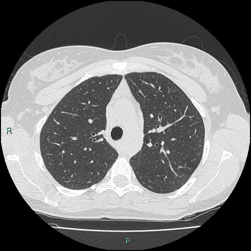 File:Accidental foreign body aspiration (seamstress needle) (Radiopaedia 77740-89983 Axial lung window 21).jpg