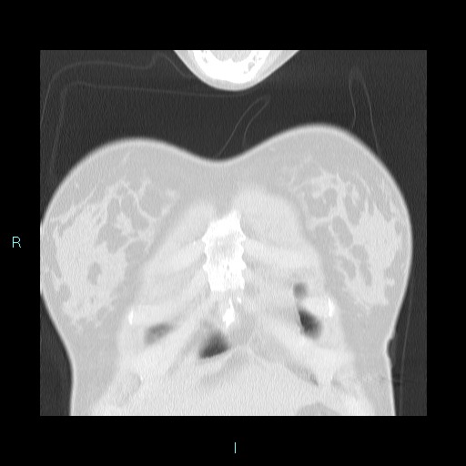 Accidental foreign body aspiration (seamstress needle) (Radiopaedia 77740-89983 Coronal lung window 60).jpg