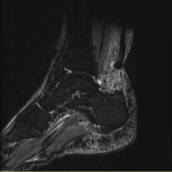 File:Achilles tendon rupture (Radiopaedia 11159-11524 None 1).jpg