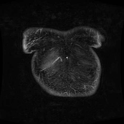 Acinar cell carcinoma of the pancreas (Radiopaedia 75442-86668 Coronal T1 C+ fat sat 182).jpg