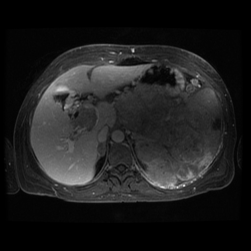 Acinar cell carcinoma of the pancreas (Radiopaedia 75442-86668 D 90).jpg