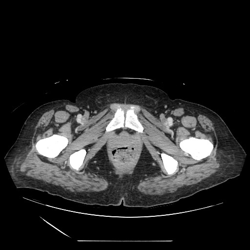 File:Acinar cell carcinoma of the pancreas (Radiopaedia 75442-86669 Axial C+ portal venous phase 150).jpg