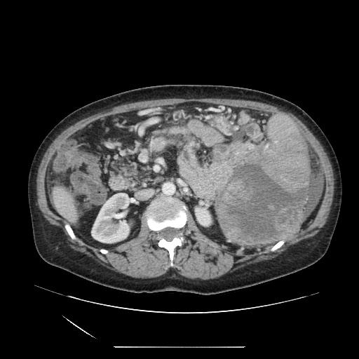 File:Acinar cell carcinoma of the pancreas (Radiopaedia 75442-86669 Axial C+ portal venous phase 59).jpg