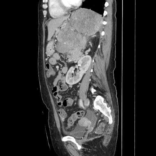 File:Acinar cell carcinoma of the pancreas (Radiopaedia 75442-86669 Sagittal C+ portal venous phase 117).jpg