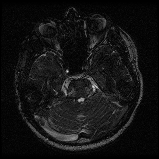 Acoustic schwannoma (Radiopaedia 33045-34060 Axial T2 55).png