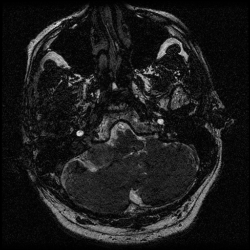 File:Acoustic schwannoma (Radiopaedia 39170-41387 Axial FIESTA 41).png