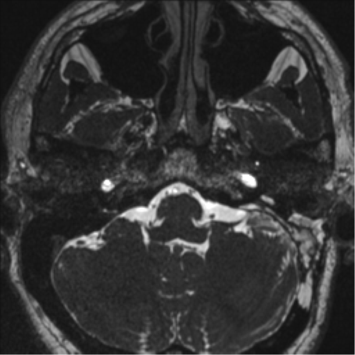 Acoustic schwannoma (translabyrinthine resection) (Radiopaedia 43570-46972 Axial CISS 19).png