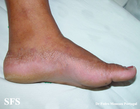 Acrokeratoelastoidosis (Dermatology Atlas 2).jpg