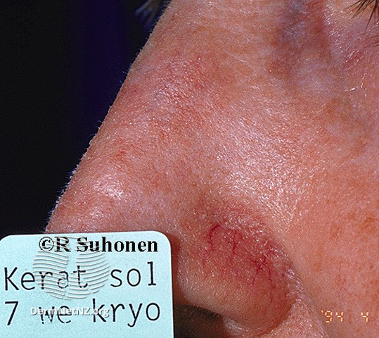 Actinic Keratoses affecting the face (DermNet NZ lesions-ak-face-234).jpg