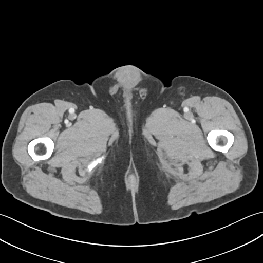 File:Active diverticular hemorrhage (Radiopaedia 39415-41725 Axial C+ portal venous phase 83).png