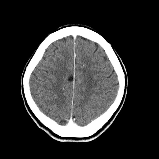 File:Active neurocysticercosis before and after therapy (Radiopaedia 71710-82099 Axial C+ delayed 23).jpg
