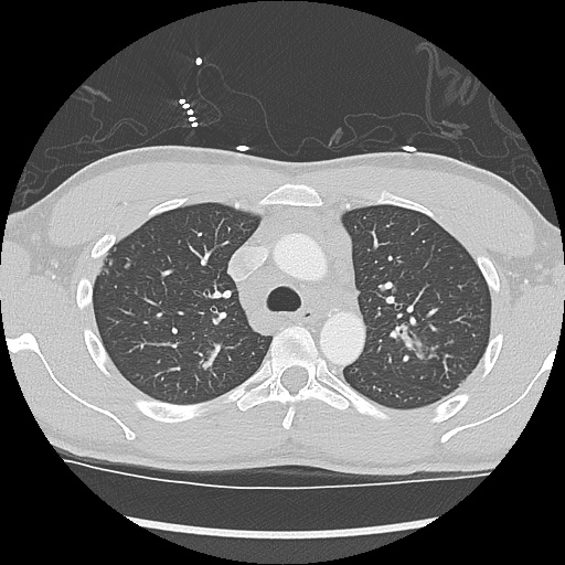 File:Active right ventricular cardiac sarcoidosis (Radiopaedia 55596-62101 Axial lung window 10).jpg