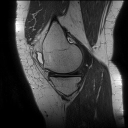 File:Acute-on-chronic transient lateral patellar dislocation with trochlear dysplasia (Radiopaedia 84099-99349 Sagittal PD 50).jpg