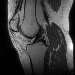 Acute-on-chronic transient lateral patellar dislocation with trochlear dysplasia (Radiopaedia 84099-99349 Sagittal PD 85).jpg
