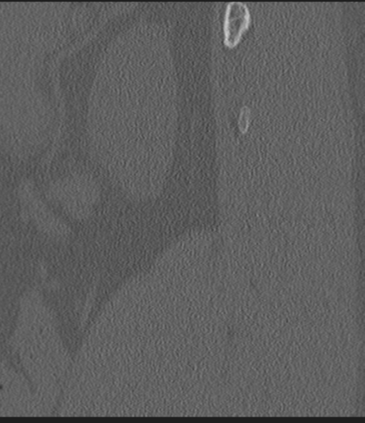 Acute L1 burst compression fracture (Radiopaedia 34430-35755 Sagittal bone window 6).png