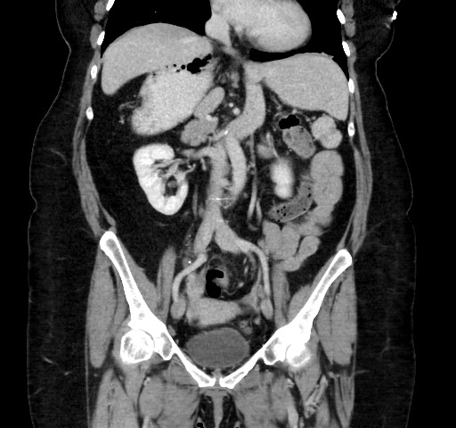Acute appendicitis, heterotaxy syndrome (Radiopaedia 66884-76202 Coronal C+ portal venous phase 63).jpg