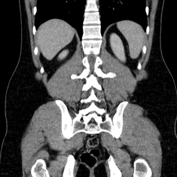 Acute appendicitis (Radiopaedia 38255-40270 Coronal C+ portal venous phase 66).jpg