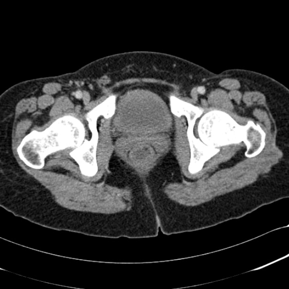 Acute appendicitis (Radiopaedia 48792-53822 Axial C+ portal venous phase 117).jpg