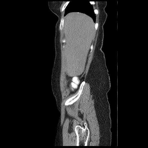 File:Acute appendicitis (Radiopaedia 52672-58589 Sagittal C+ arterial phase 5).jpg