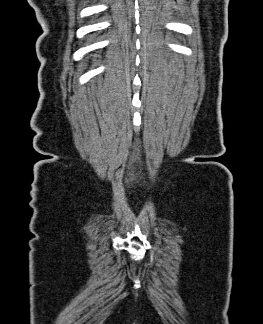 Acute appendicitis (Radiopaedia 58627-65818 Coronal non-contrast 60).jpg