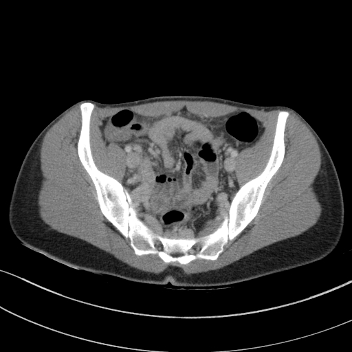 File:Acute appendicitis (Radiopaedia 62608-70901 Axial C+ portal venous phase 27).jpg