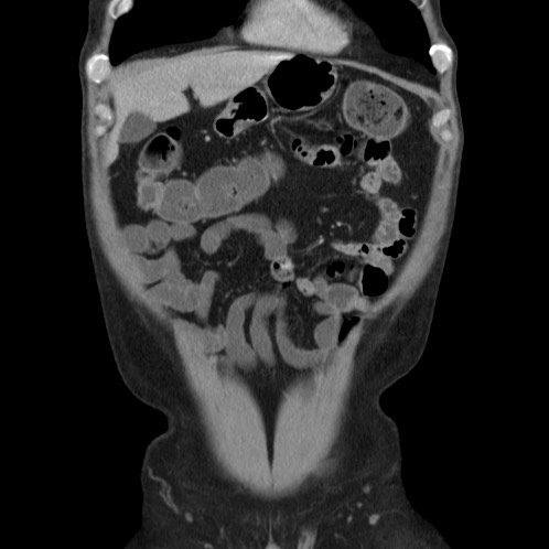 Acute appendicitis (Radiopaedia 66513-75790 Coronal C+ portal venous phase 7).jpg