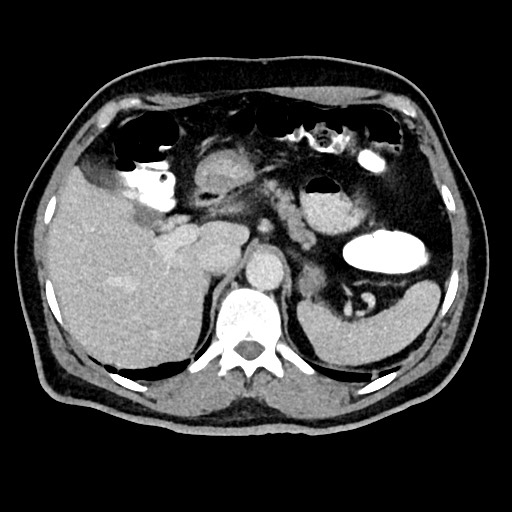 Acute appendicitis (Radiopaedia 77016-88960 Axial C+ portal venous phase 37).jpg