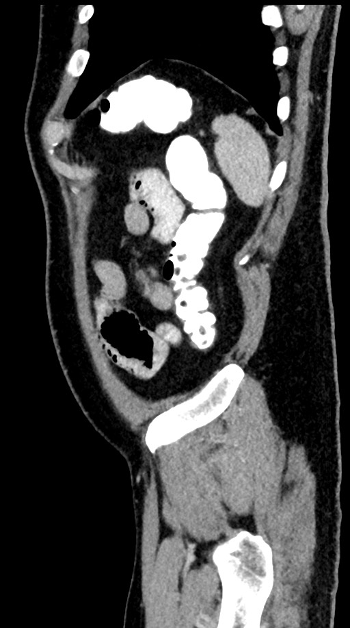 Acute appendicitis (Radiopaedia 77016-88960 Sagittal C+ portal venous phase 17).jpg