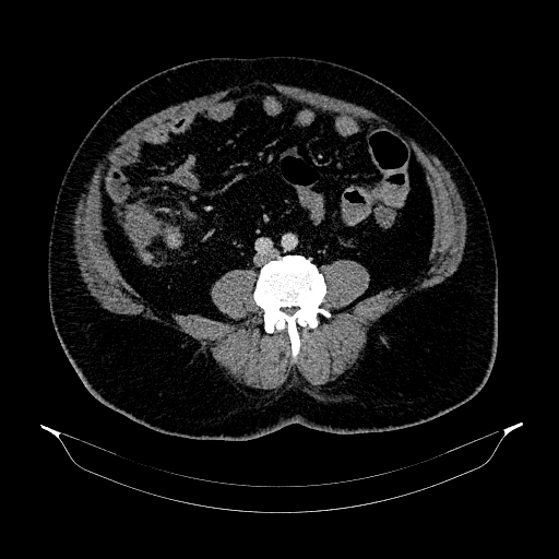 Acute appendicitis (Radiopaedia 79950-93224 Axial C+ portal venous phase 64).jpg
