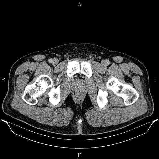 Acute appendicitis (Radiopaedia 84780-100240 Axial C+ portal venous phase 112).jpg