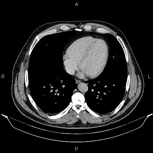 File:Acute appendicitis (Radiopaedia 84780-100240 Axial C+ portal venous phase 4).jpg