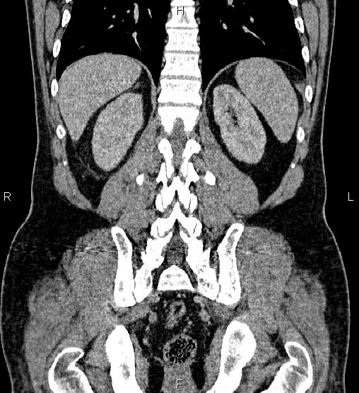 Acute appendicitis (Radiopaedia 84780-100240 Coronal C+ portal venous phase 62).jpg