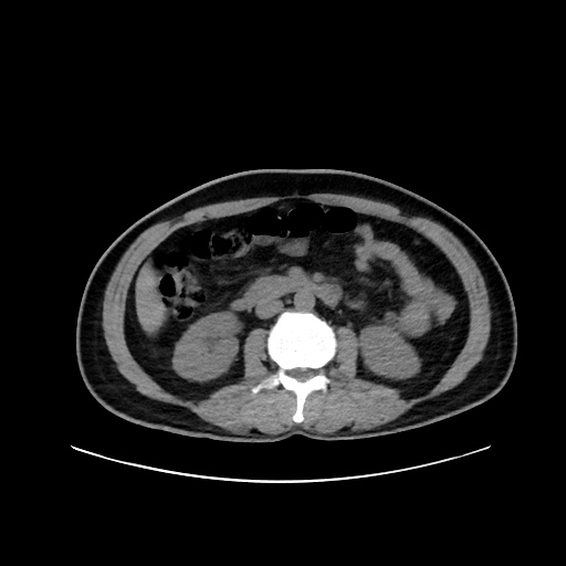 Acute appendicitis and COVID 19 pneumonia (Radiopaedia 76604-88380 Axial non-contrast 73).jpg