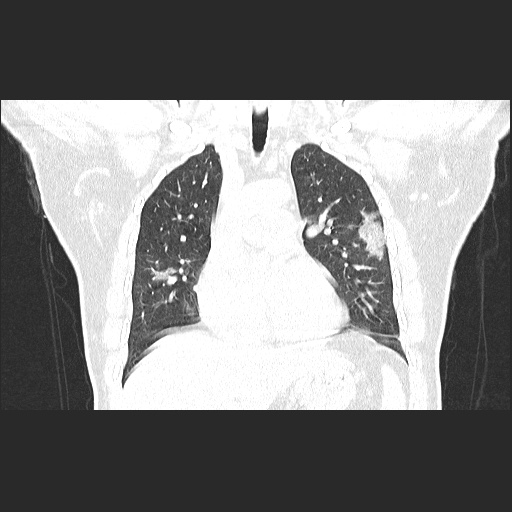 File:Acute appendicitis and COVID 19 pneumonia (Radiopaedia 76604-88380 G 27).jpg