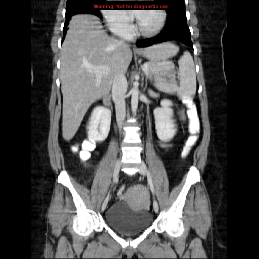 File:Acute appendicitis complicated by ovarian vein thrombophlebitis (Radiopaedia 16172-15851 Coronal C+ portal venous phase 44).jpg