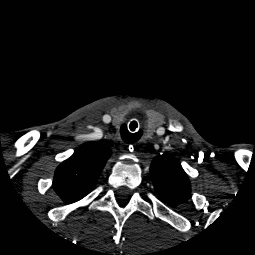 Acute basilar artery occlusion (Radiopaedia 43582-46985 Axial C+ arterial phase 285).jpg