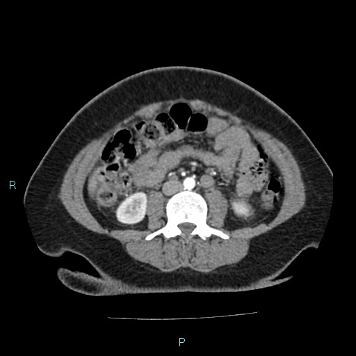 Acute bilateral pyelonephritis (Radiopaedia 37146-38881 Axial C+ arterial phase 106).jpg