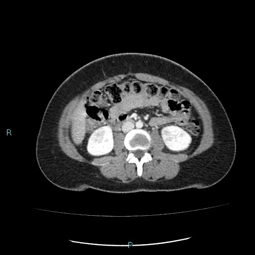 File:Acute bilateral pyelonephritis (Radiopaedia 37146-38881 Axial C+ portal venous phase 53).jpg