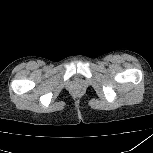 Acute bilateral pyelonephritis (Radiopaedia 74153-84969 Axial non-contrast 52).jpg