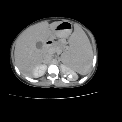 File:Acute calculous cholecystitis in patient with osteopetrosis (Radiopaedia 77871-90159 Axial C+ delayed 9).jpg