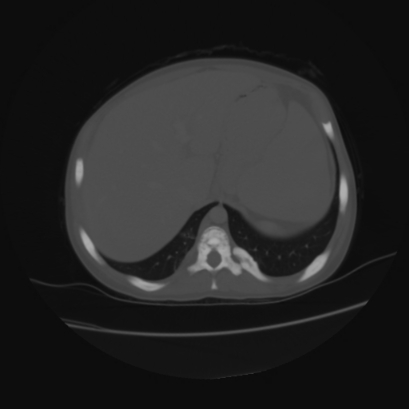 File:Acute calculous cholecystitis in patient with osteopetrosis (Radiopaedia 77871-90159 Axial bone window 9).jpg
