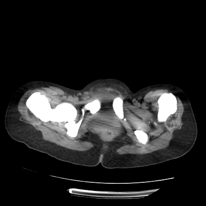 File:Acute calculous cholecystitis in patient with osteopetrosis (Radiopaedia 77871-90159 Axial non-contrast 80).jpg